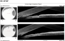 Figs. 4 and 5. Angle OCT shows a 20 degree angle OD and a 15 degree OS.