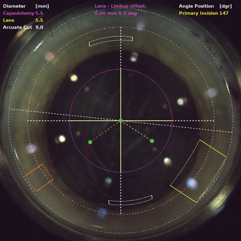 OCT during laser cataract surgery allows the cataract surgeon to plan the location and depth of incisions. 