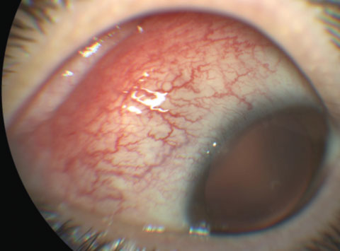 Fig. 1. Nasal and superonasal conjunctival injection.