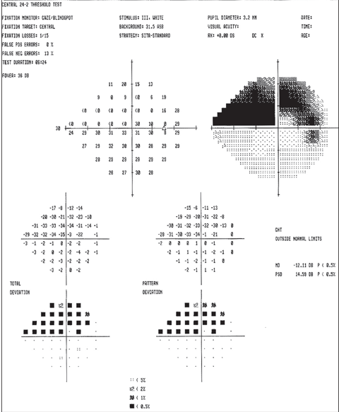 The visual field shows a dense glaucomatous arcuate scotoma in the right eye. 