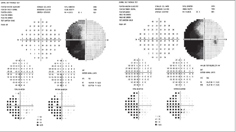 Example of left hemianopsia due to stroke.