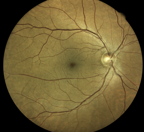 An Eidon True Color Confocal Scanner was used to image this PDR with an area of NVE at 10 o’clock. Below, this image shows a patient with mild nonproliferative diabetic retinopathy. Note the three dot hemorrhages superior to the macula.