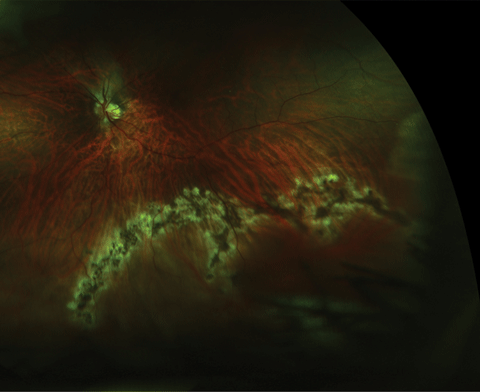 Post-treatment UWFI of the same patient.