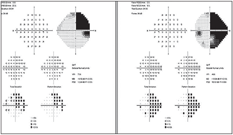 Visual field three weeks after initial visit. Visual field in the right eye had improved, but the left remained unchanged.