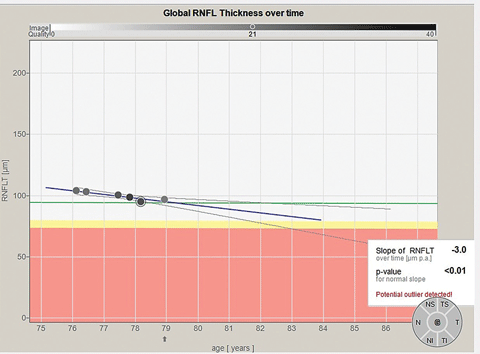 Global optic nerve RNFL data over time. Note the slight decline in global RNFL thickness over time, implying slow progression.