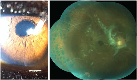 This patient has had a number of ocular pathologies in the past, but can you tell what’s causing his blurred vision from this photograph? What can be learned from this fundus image of the patient’s left eye?