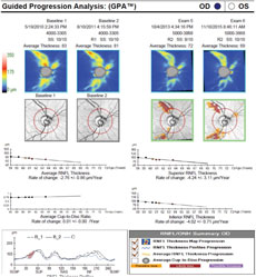 Case two’s RNFL thickness map shows loss of superior and inferior RNFL over five years.