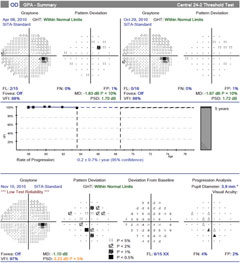 Over the same period of time with case two, there is no confirmed visual field progression, although numerous points tested have changed from baseline (clinician observation indicated good fixation throughout the test).