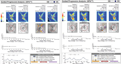 In the patient on the left, note the reduced signal strength and motion artifact (discontinuity of blood vessels) on exam three. When the scan was repeated, the signal strength was improved and the suspected change was not confirmed. In the patient on the right, note the high variability of the inferior RNFL measurement, most likely the result of the vitreous floater impacting the scan.