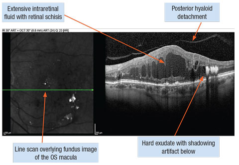 Diffuse diabetic macular edema captured with spectral-domain OCT line scans.