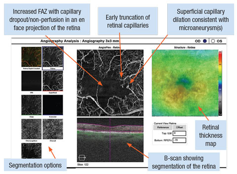 OCT-A with Cirrus OCT Angioplex highlighting a 3x3mm box around the OD macula. The image shows an increased foveal avascular zone with capillary dropout and truncation. Focal dilations of capillary vessels are notated in locations of microaneurysm(s).