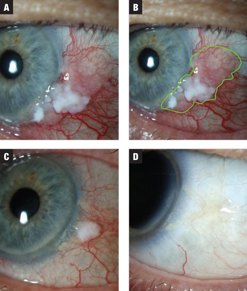 Fig. 1a. In case 1, the lesion has both leukoplakic and gelatinous zones. Treatment was initiated at MMC 0.02% QID. Fig. 1b. Estimated extent of lesion highlighted. Fig. 1c. After the first three-week course, the lesion shows dramatic reduction in size. The patient was placed on a washout period of two weeks and instructed to anticipate a second course of MMC. Fig. 1d. Lesion showed complete resolution following washout.