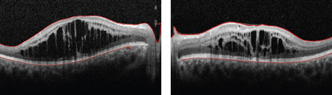 Figs. 1a and 2b. This 19-year-old patient presented with progressive blurring in the right eye and decreased night vision. What can these OCT findings tell you?