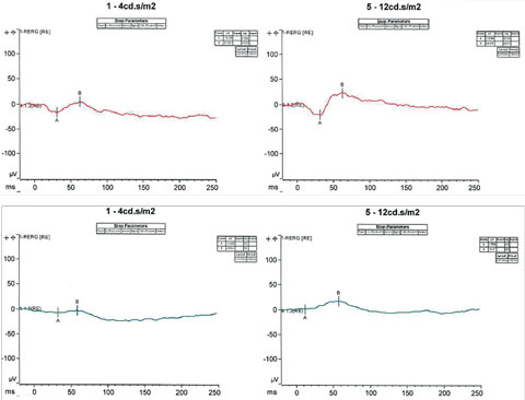 Fig. 5. S-cone protocol testing involves saturating the L and M cones, such that only the functions of S-cones are tested. Under certain specific intensities, our patient exhibited a response with an increased amplitude of approximately two to three fold outside the normative values.