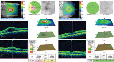 The OCT on the left shows a patient with CME. This was successfully resolved with Durezol BID OS and Ilevro QD OS over a nine-week period, as seen in the right OCT. 