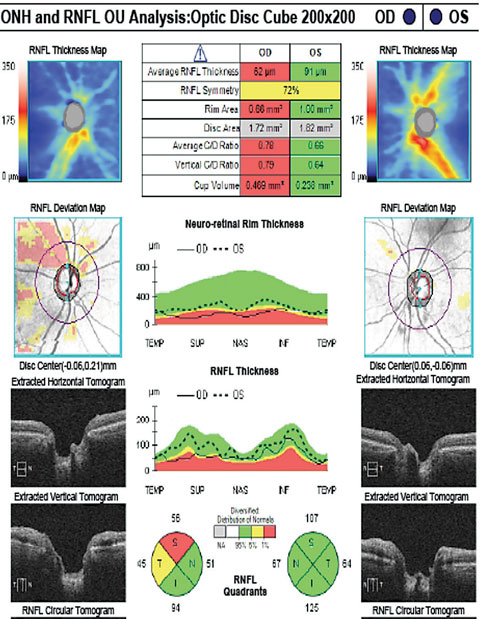 The patient’s RNFL scan shows superior and temporal rim thinning in the right eye.  