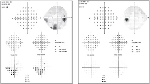 Visual fields show the inferior arcuate in the right eye that correlates with RNFL and GCA. The fields are clean in the left eye.