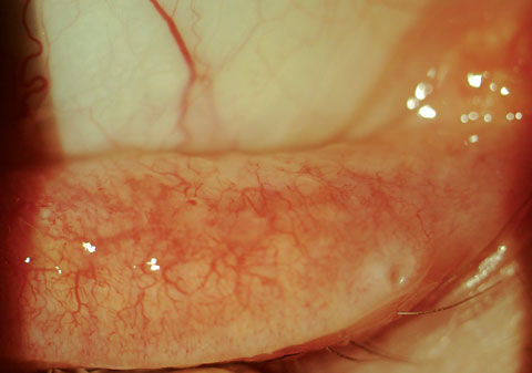 When patients suffer from ocular inflammation due to allergy, as seen here, education about avoidance of triggers is a vital aspect of treatment.