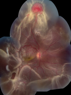 Extensive circumferential retinal detachment is secondary to a retinal capillary hemagioma in Von Hippel-Lindau disease.