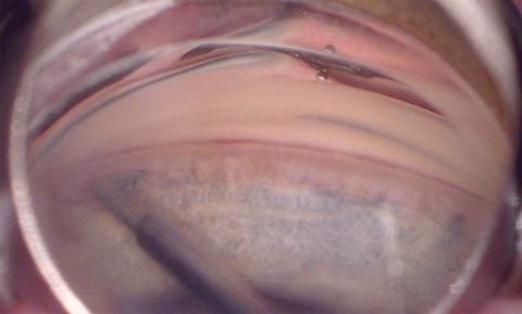 The Kahook Dual Blade removes the trabecular meshwork and the inner wall of Schlemm’s canal to enable better IOP control. Here, the retinal architecture is partially obscured, indicative of macular thickening. 