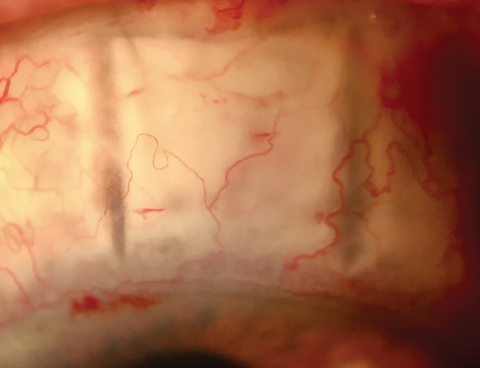 Variations of trabeculectomy, such as non-penetrating deep sclerectomy, seen here early post-op, further improve surgical outcomes for patients with advanced disease.