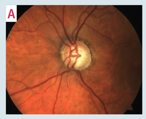 This 76-year-old patient has early-moderate primary open-angle glaucoma in the left eye and is a high-risk glaucoma suspect in the right. His IOPs were stable with current topical ocular hypotensive medications. Gonioscopy was normal OU and pachymetry measurements were thinner than average, 504μm OD and 508μm OS. Despite limited commitment to follow-up, his most recent 24-2 for his left eye confirmed overall stable superior paracentral defects, which were consistent with inferior neuroretinal rim thinning (A) and moderate inferior/inferior-temporal RNFL loss on OCT testing. The patient’s current 24-2 test pattern isn’t sufficient to fully understand his level of visual impairment and reliably monitor for glaucomatous progression. Central 10-2 testing, however, can help reveal the risk of potential visual impairment and better monitor for disease progression.