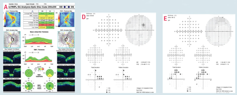 This patient has detectable rim loss upon optic nerve evaluation and OCT testing (A) with correlating nasal step visual field defects OU, more so in the right eye than the left, and presumed minimal central involvement on visual field 24-2 testing, again more so in the right eye than the left. Central 10-2 visual field testing shows that 24-2 testing underestimates these potential central defects (D and E).