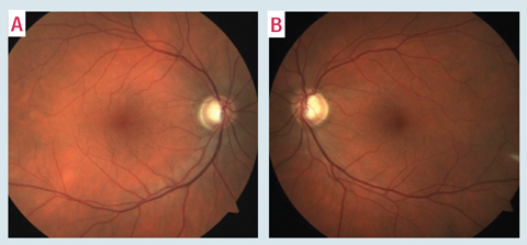 This patient has superior rim thinning. 