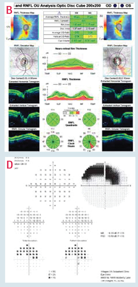 Despite relatively mild inferior temporal neuroretinal rim loss in this patient’s right eye with confirmed RNFL loss on OCT (B), and regardless of the status of the rest of the visual field, this patient has advanced visual field loss on 24-2 visual field testing. Due to this deep central involvement, 10-2 visual field testing is critical to better understand the significance of this defect and monitor for progression (D).