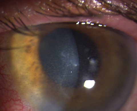 Keratic precipitates with anterior chamber reaction and stromal haze, which are hallmarks of HSV endothelial keratitis. Photo: Lisa Martén, MD