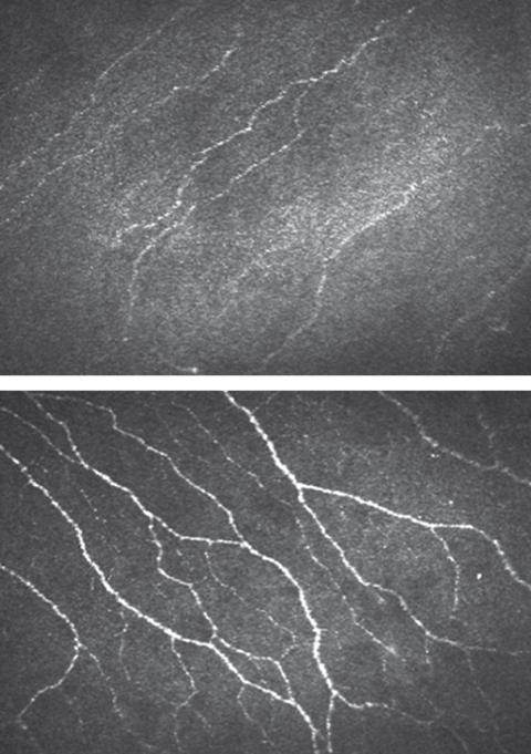 Confocal microscopy shows lower nerve fiber density in patients with diabetes (top) compared with controls (bottom). Images: Maria Markoulli, PhD, MOptom