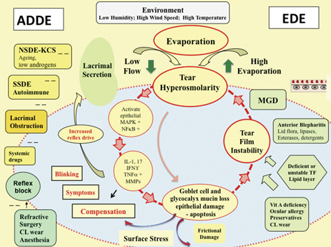 Fig. 1. THE VICIOUS CYCLE OF DRY EYE DISEASE. The core mechanism of DED is tear hyperosmolarity, the hallmark of the disease. It damages the ocular surface both directly and by initiating inflammation. The cycle of events is shown at the center of the figure.   Two forms of DED are recognized, ADDE and EDE. In ADDE, hyperosmolarity results when lacrimal secretion is reduced, in conditions of normal evaporation. In EDE, tear hyperosmolarity is caused by excessive evaporation from the exposed tear film in the presence of a normally functioning lacrimal gland. Since tear osmolarity can only arise as a result of tear evaporation in both ADDE and EDE, hyperosmolarity is due to evaporation from the ocular surface and, in that sense, all forms of DED are evaporative. EDE is a hyper-evaporative state.   In DED, hyperosmolarity is considered to set up a cascade of signaling events in surface epithelial cells that leads to the release of inflammatory mediators and proteases. Such mediators, together with the hyperosmolarity itself, are conceived to cause goblet and epithelial cell loss and damage to the epithelial glycocalyx. Damage is reinforced by inflammatory mediators from activated T-cells, recruited to the ocular surface. The net result is the characteristic punctate epitheliopathy of DED and tear film instability, which leads to early tear film break-up. This exacerbates and amplifies hyperosmolarity and completes the vicious circle events that produce ocular surface damage. Ultimately, this is thought to lead to self-perpetuation of the disease. Adapted and reprinted from Ocular Surface (2017) 441–515, Bron AJ, de Paiva CS, Chauhan SK, et al. TFOS DEWS II pathophysiology report, p. 460, © 2017, with permission from Elsevier.