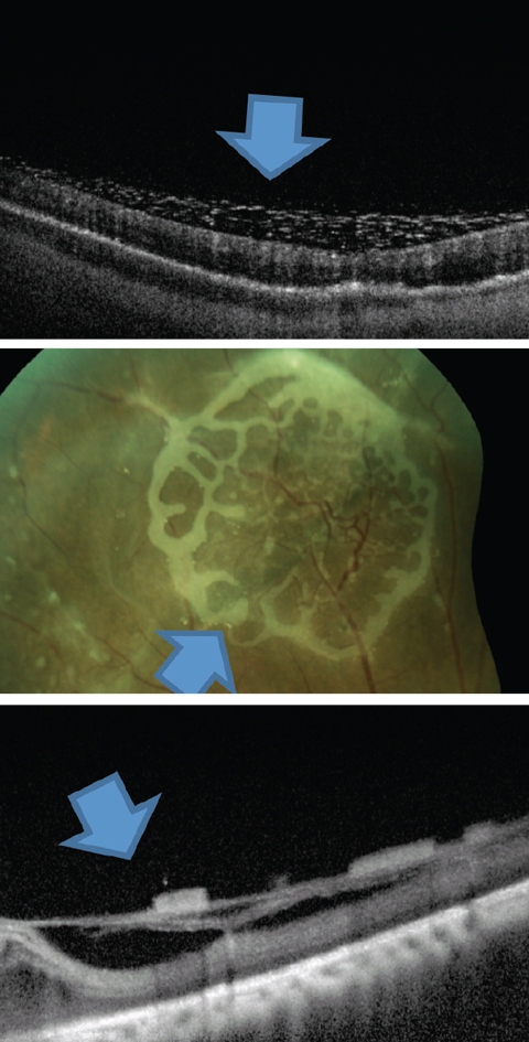 Fig. 7. This is one presentation of emulsified silicone seen on the retinal surface. 