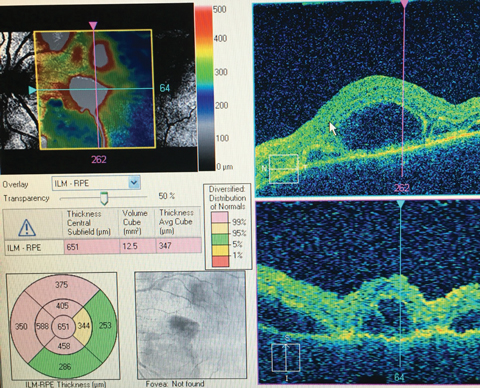 This OCT readout shows a 68-year-old female patient who presented with trouble reading.