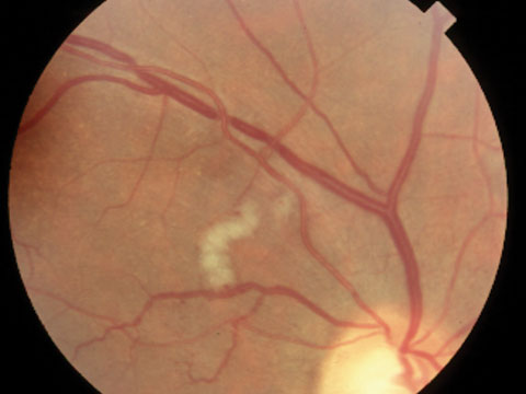 Arteriolosclerosis and venous compression in hypertension.