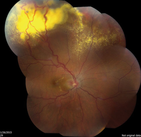 Fig. 2. Note the peripheral changes in this widefield view of the same eye.