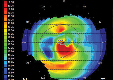 Fig. 1. Irregular astigmatism caused by map-dot-fingerprint dystrophy.