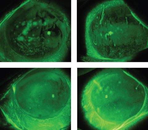 These images depict a GVHD patient’s eyes before (top) and after scleral lens wear, showing an improved ocular surface, including a reduction in filaments, after just a few hours of wearing time. Photos: Alan Kwok, OD