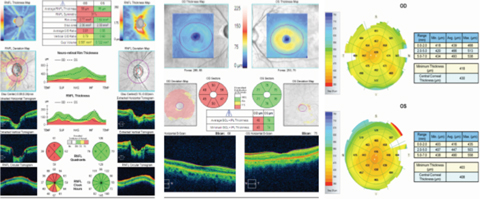 OCT imaging suggests the patient’s elevated IOP was connected to narrowed angles. 