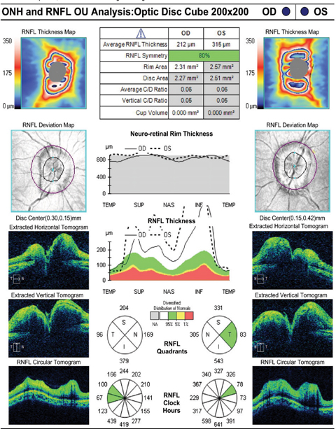 Fig. 2. How would you interpret these retinal nerve fiber layer OCT findings in our patient?