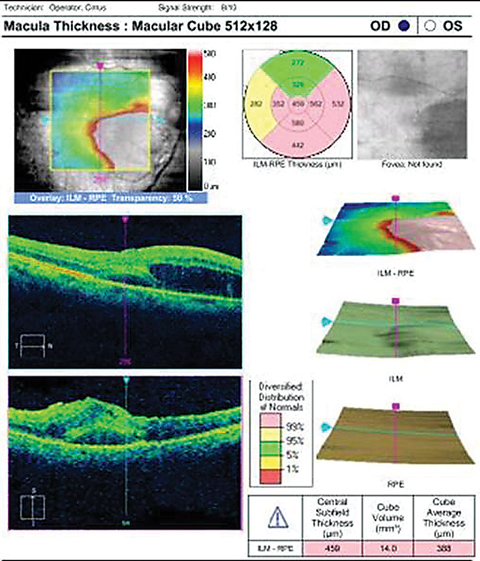 OCT imaging of our 76-year-old patient who complained of a “dark spot” in her vision. 