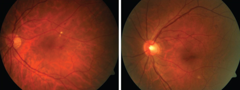 By teaching AI software to distinguish from mild (left) and moderate (right) non-proliferative DR, researchers demonstrated an AI algorithm’s viability as a screening tool. The system identified ‘referable’ cases—moderate or worse DR—with sensitivities ranging from 87% to 97.5%, and specificity of 94%.