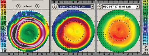 Fig. 3. The same patient’s one week follow up shows complete resolution of the central island—without any changes to the prescribed lens.