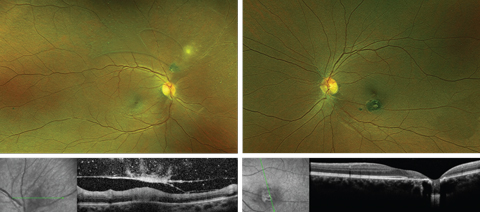 Figs. 1 & 2. Fundus photo and OCT of the right eye (left) and left eye (right).