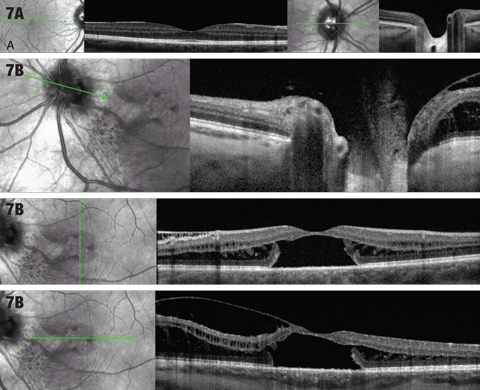 Fig. 7. (A) OCT cross sections through macula and optic nerve of right eye. (B) OCT cross sections through macula and optic nerve of the left eye.