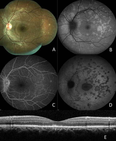 Fig. 10. (A) Fundus photograph; (B) FAF; (C) late FA; (D) late ICGA; (E) OCT. 