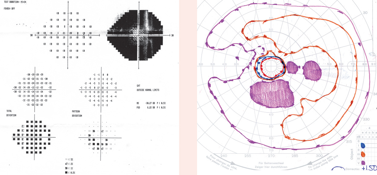 At left, based on 24-2 threshold related testing,  the examiner felt the patient’s visual field was severely constricted. At right, full-field testing shows a restricted field under lower light conditions and a significantly fuller field under full light conditions.