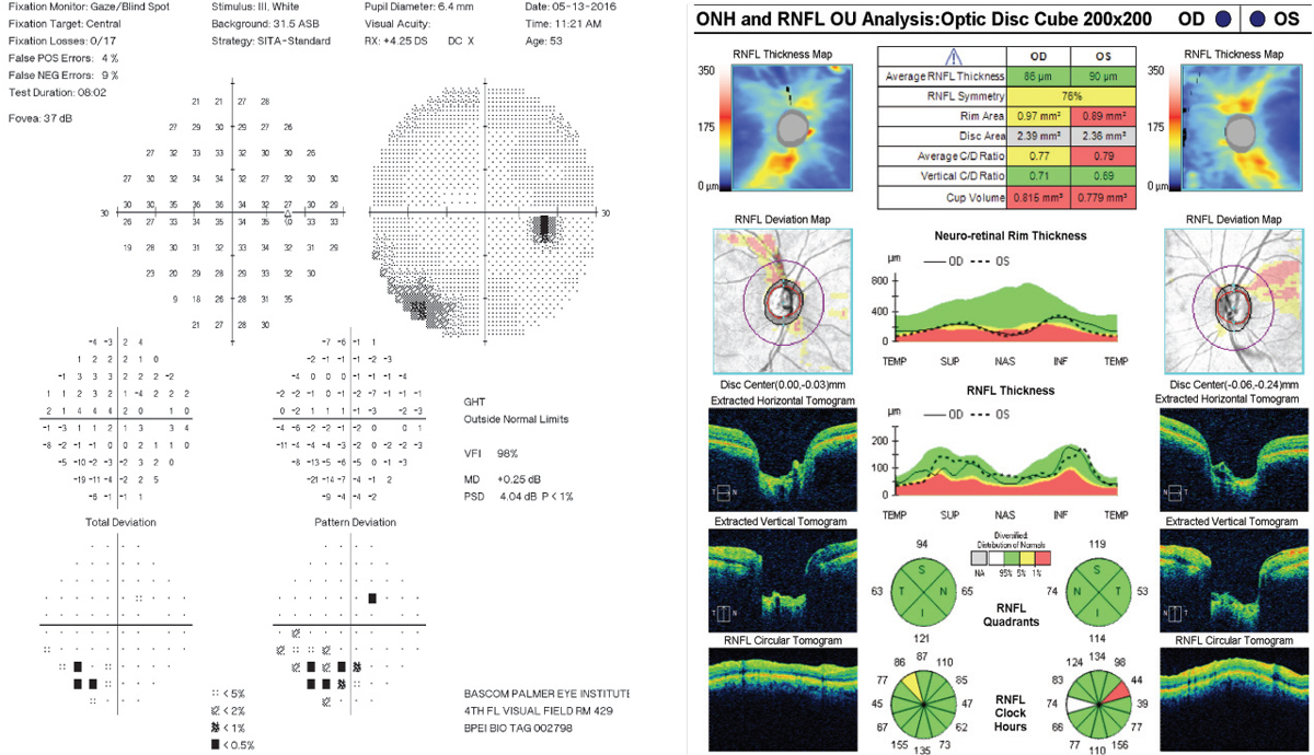 Fig. 2. How do you explain the visual changes, at right, in the patient’s right eye? Based on the RNFL, could this patient have glaucoma?