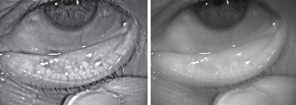 This patient below has MGD. The glands are greatly shortened compared to those above, and the areas devoid of glands indicate dropout.