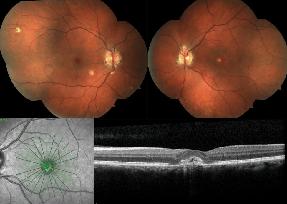 Fig. 5. This patient presented with with the OHS triad: PPA, multiple punched out lesions and early development of CNV. 